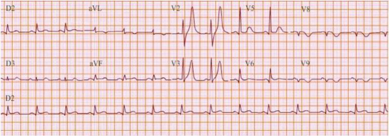 ECG